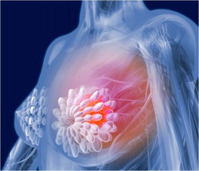 乳腺癌基因测序